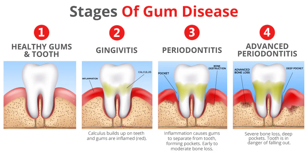 perio disease graphic