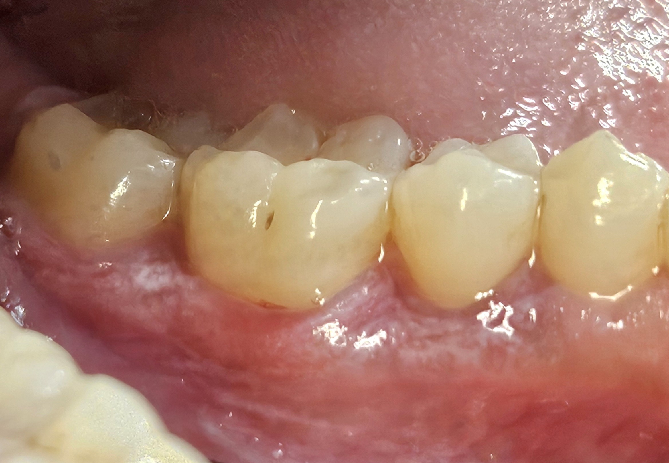 Leukoplakia biopsy in Hillsborough, NJ