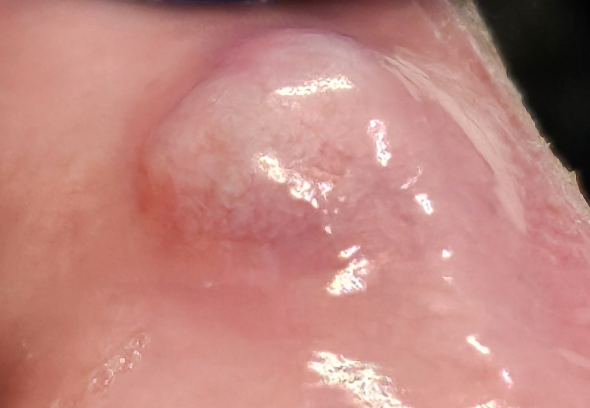 Oral fibroma biopsy in Hillsborough, NJ