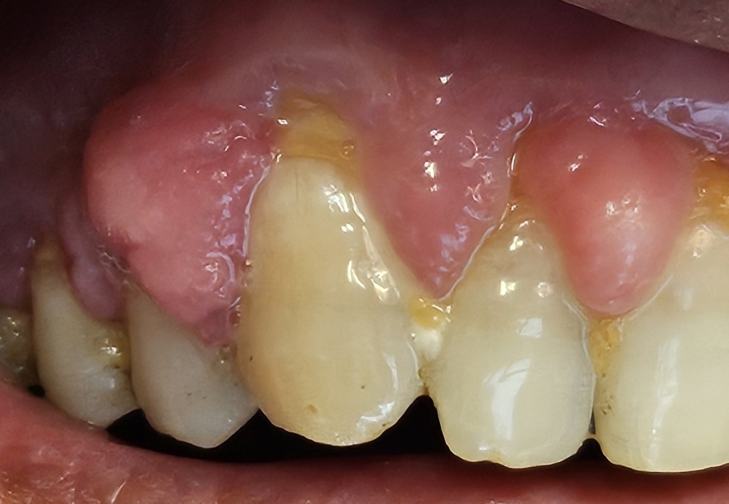 Pyogenic granuloma biopsy in Hillsborough, NJ