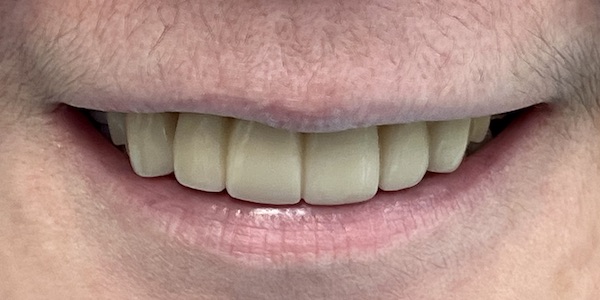 Bone Graft, Implants, Crowns, and Bridges at Precision Dental Group, Hillsborough NJ