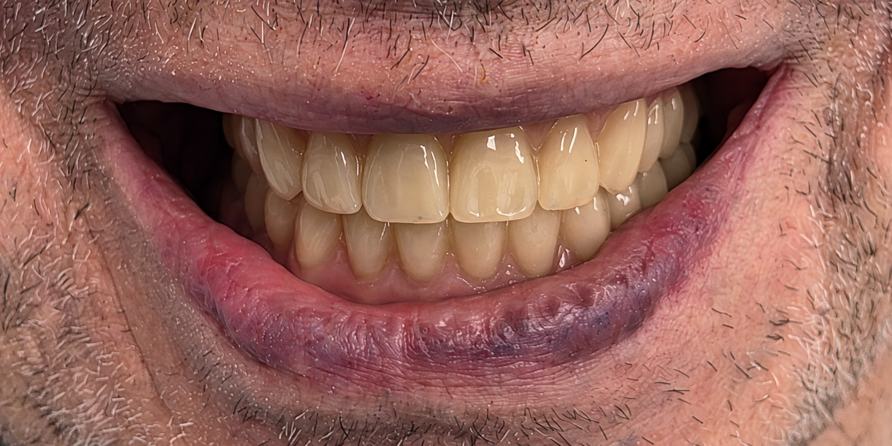 Complete Denture After Photo 1, Precision Dental Group, Hillsborough NJ