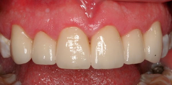Esthetic Crown Lengthening and Crown at Precision Dental Group, Hillsborough NJ