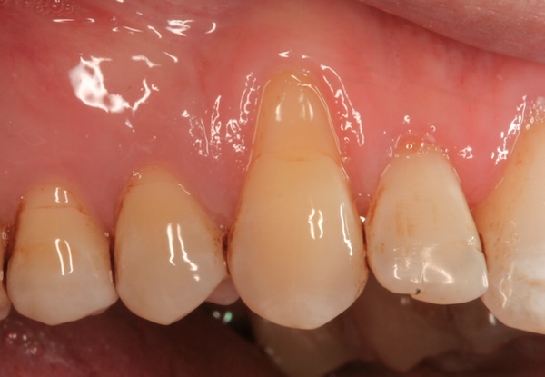 Gum graft before photo 1, Precision Dental Group, Hillsborough NJ