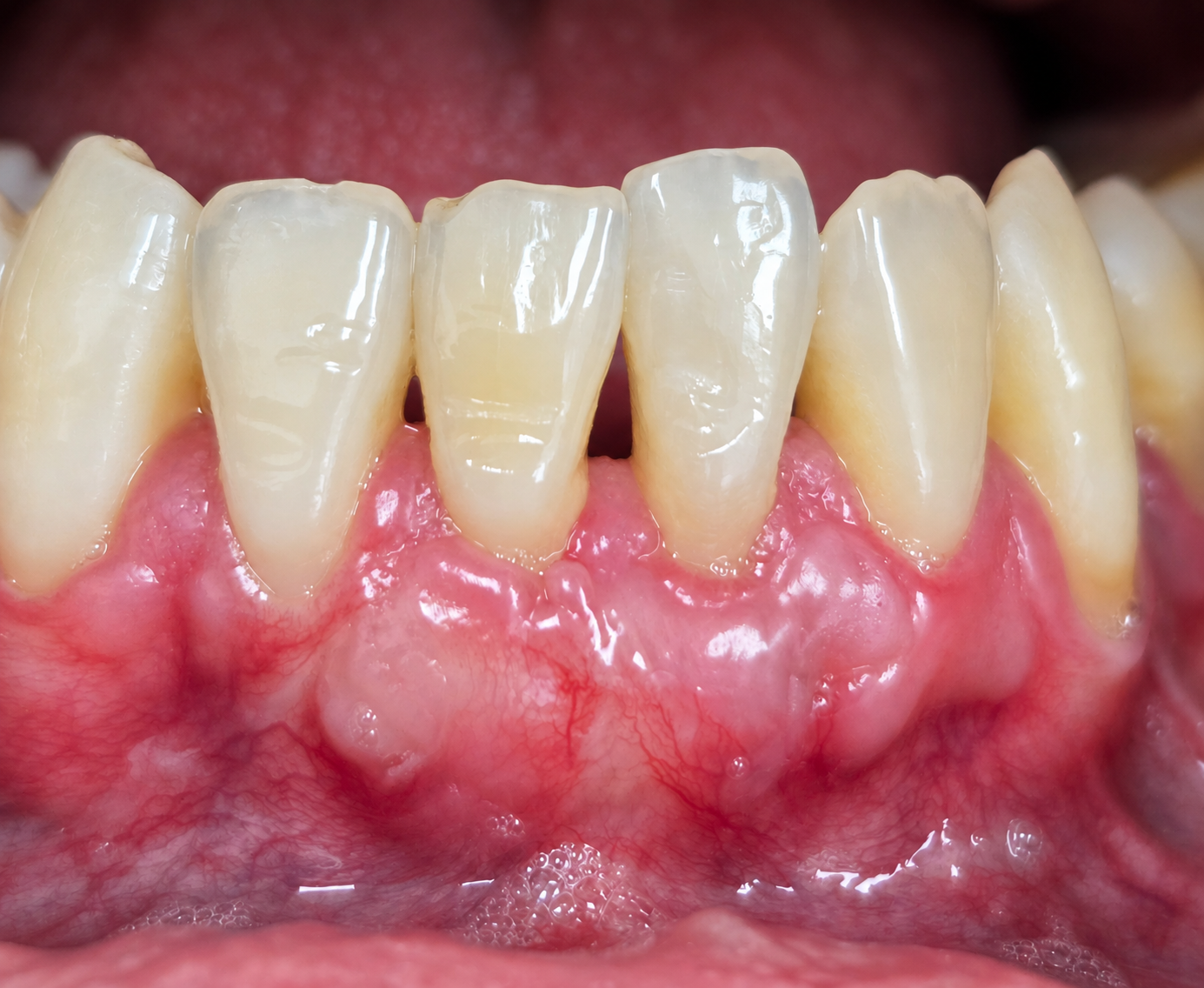 gum-graft-case-03-after-precision-dental-group-hillsborough-nj.jpg
