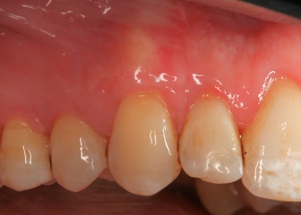 um graft after photo 1, Precision Dental Group, Hillsborough NJ