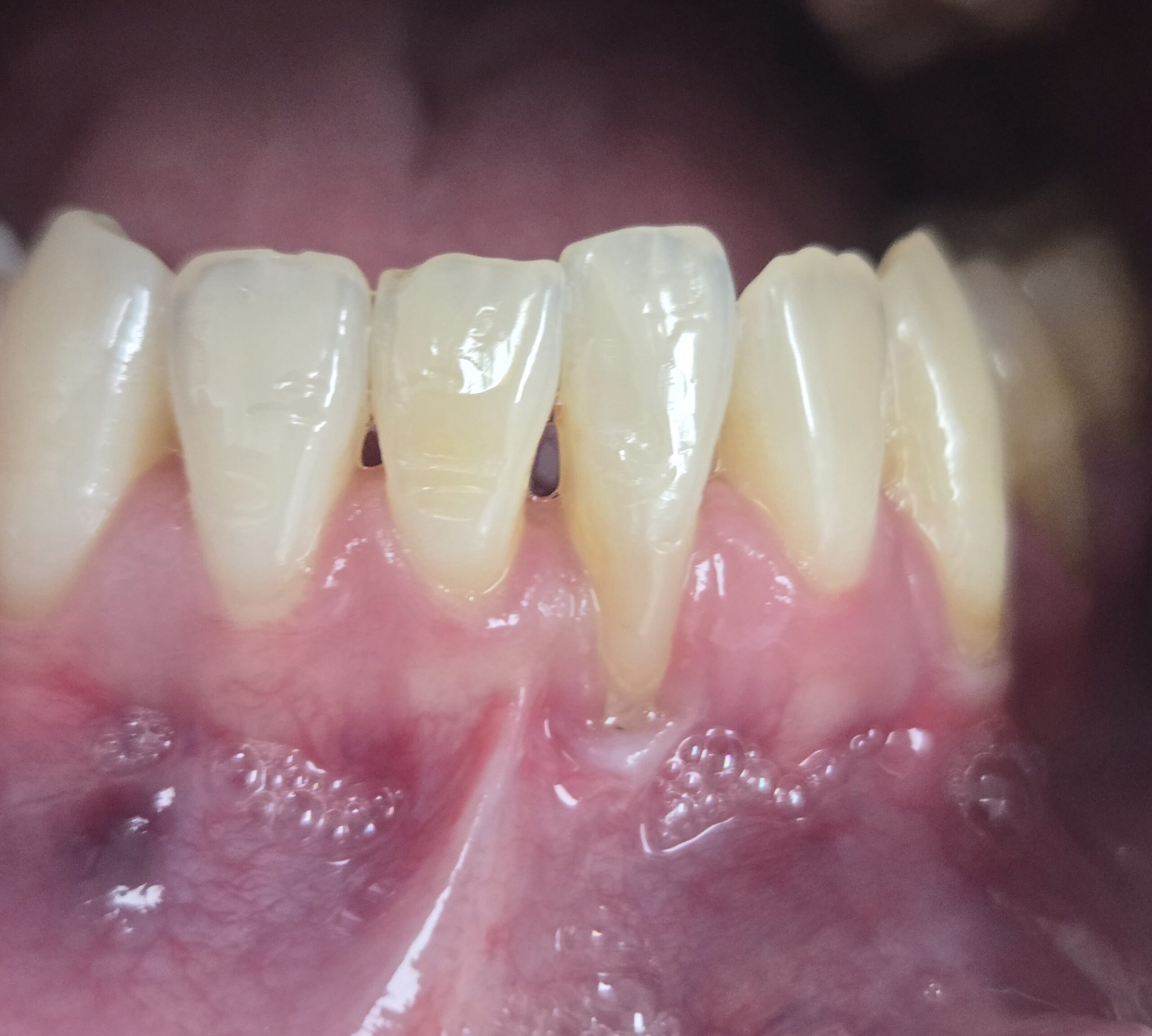gum-graft-case-03-before-precision-dental-group-hillsborough-nj.jpg