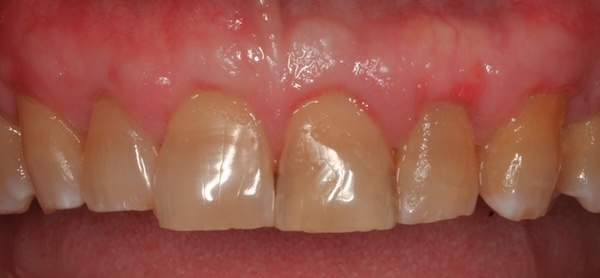 Gum graft after photo 2, Precision Dental Group, Hillsborough NJ