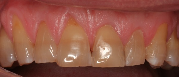 Gum graft before photo 2, Precision Dental Group, Hillsborough NJ