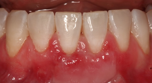 Gum graft after photo 3, Precision Dental Group, Hillsborough NJ