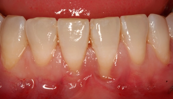 Gum graft before photo 3, Precision Dental Group, Hillsborough NJ