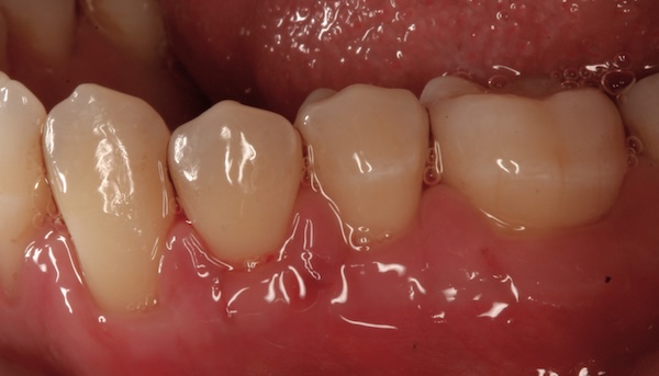 Gum graft after photo 4, Precision Dental Group, Hillsborough NJ