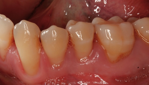 Gum graft before photo 4, Precision Dental Group, Hillsborough NJ