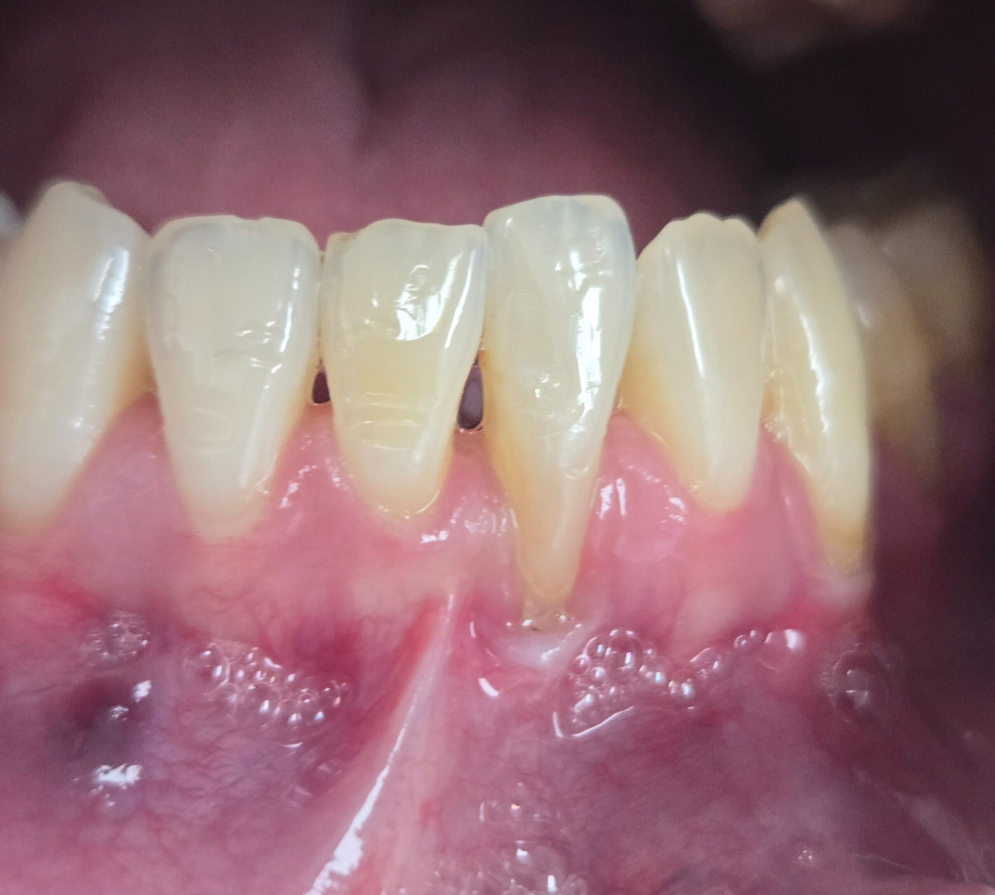 Gum graft before photo 5, Precision Dental Group, Hillsborough NJ