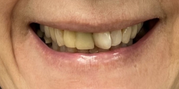 Smile Design, Dental Crowns and Bridge before and after – Precision Dental Group, Hillsborough NJ