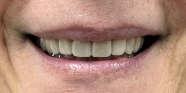 Smile Design, Dental Crowns and Bridge before and after – Precision Dental Group, Hillsborough NJ