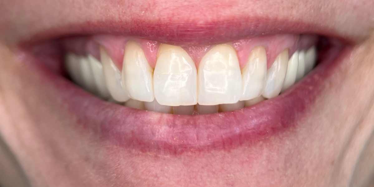 After composite veneers and bonding, Precision Dental Group, Hillsborough NJ