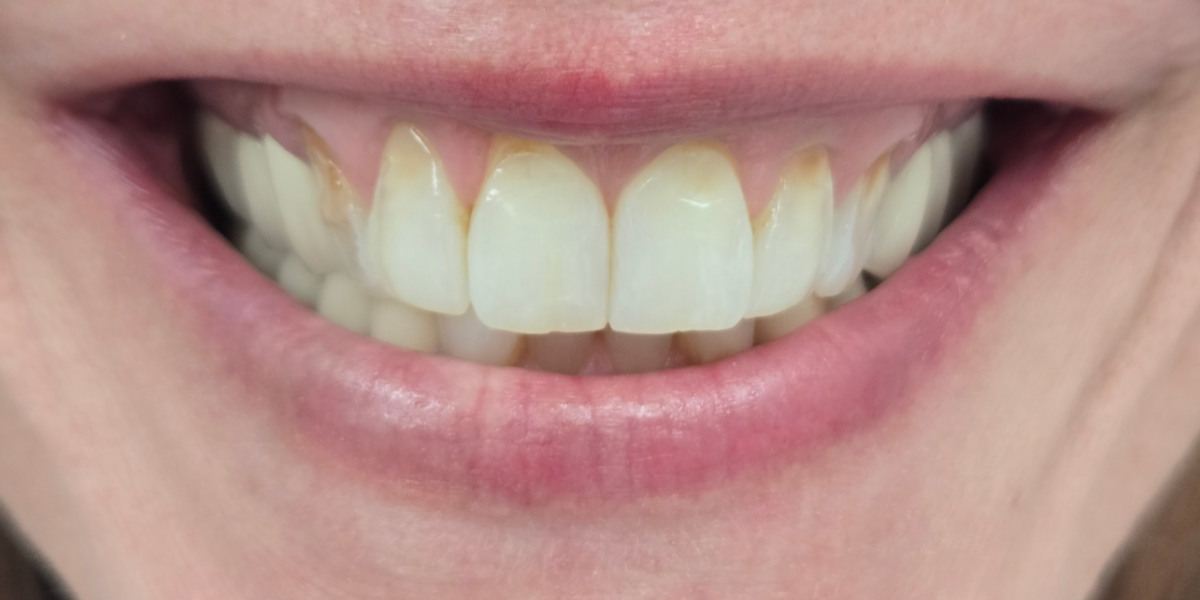 Before composite veneers and bonding, Precision Dental Group, Hillsborough NJ