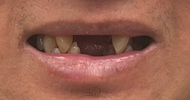 All-on-X Implant Therapy before and after – Precision Dental Group, Hillsborough NJ