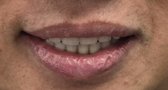 All-on-X Implant Therapy before and after – Precision Dental Group, Hillsborough NJ
