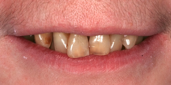 Bone Graft, Implants, Crowns, and Bridges before and after – Precision Dental Group, Hillsborough NJ