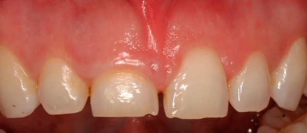 Crown Lengthening before and after – Precision Dental Group, Hillsborough NJ