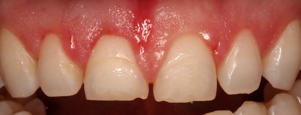 Crown Lengthening before and after – Precision Dental Group, Hillsborough NJ