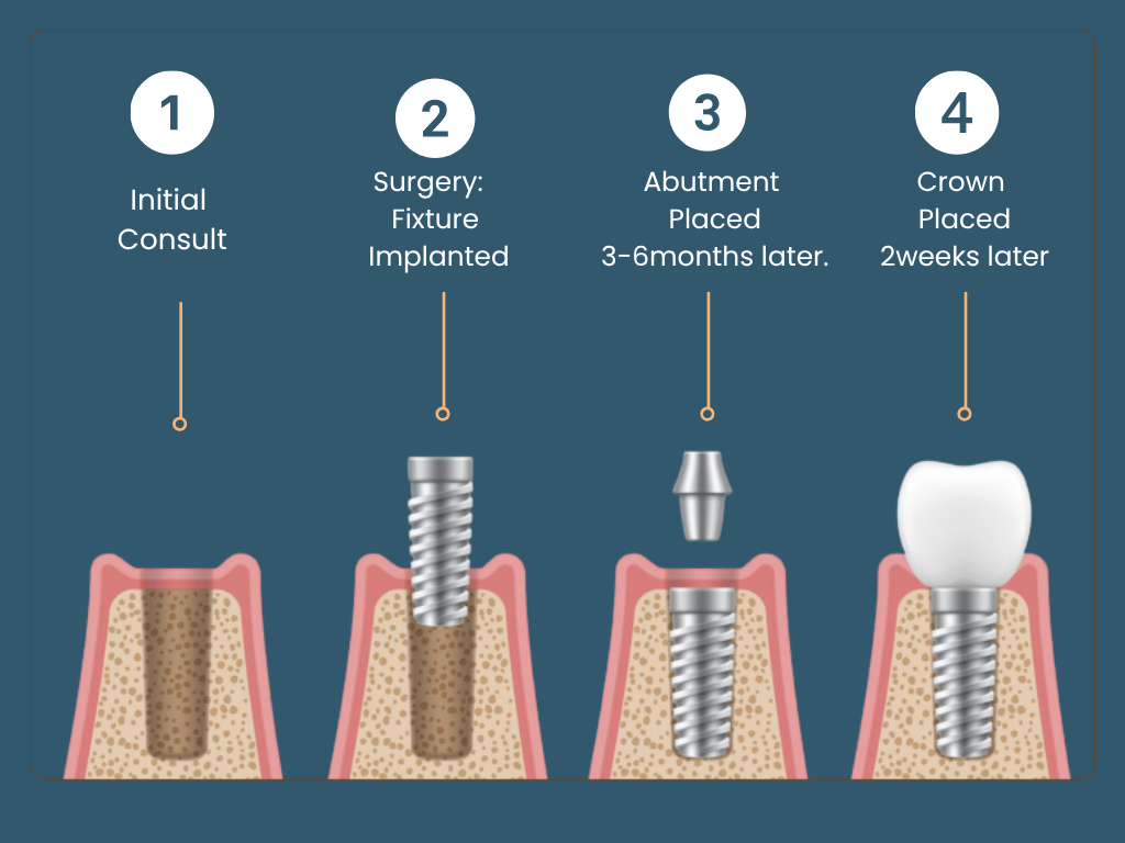 Dental implant process steps