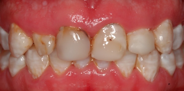 Esthetic Crown Lengthening and Crown before and after – Precision Dental Group, Hillsborough NJ